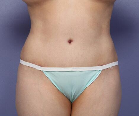 Liposuction Before & After Image