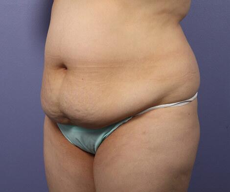 Liposuction Before & After Image