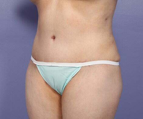 Liposuction Before & After Image