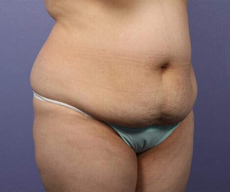 Liposuction Before & After Image