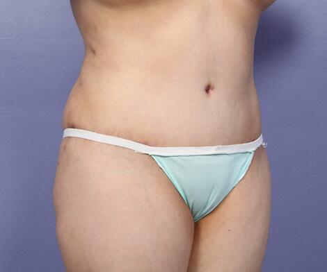 Liposuction Before & After Image