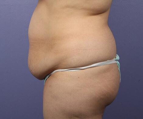 Liposuction Before & After Image