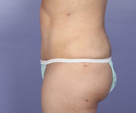 Liposuction Before & After Image