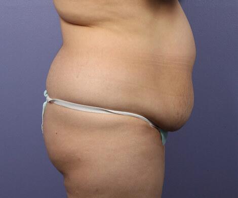 Liposuction Before & After Image