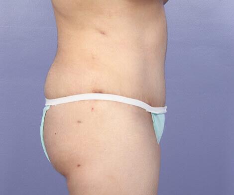 Liposuction Before & After Image