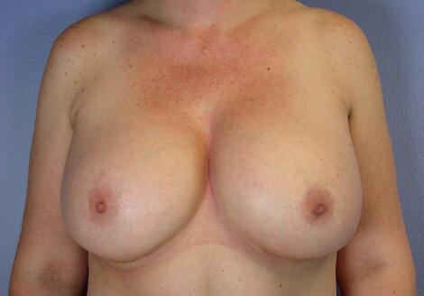 Liposuction Before & After Image