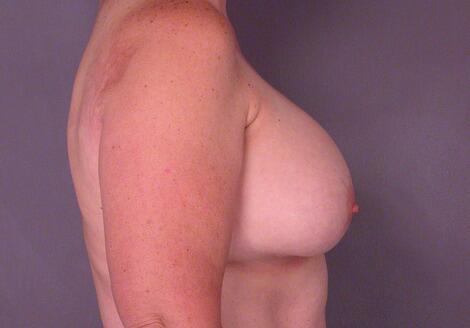 Liposuction Before & After Image