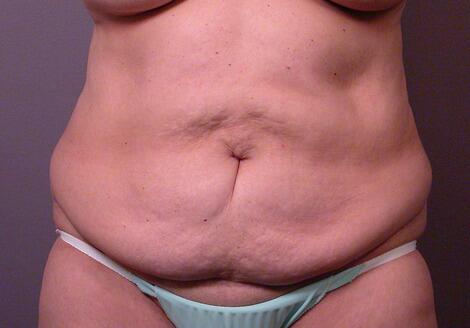 Liposuction Before & After Image