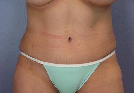 Liposuction Before & After Image