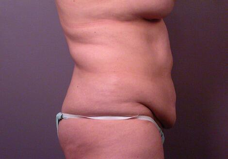 Liposuction Before & After Image