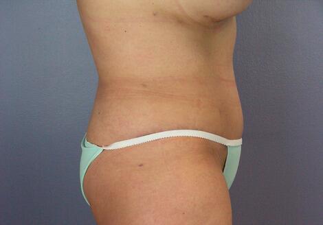 Liposuction Before & After Image