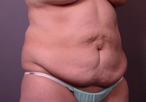 Liposuction Before & After Image