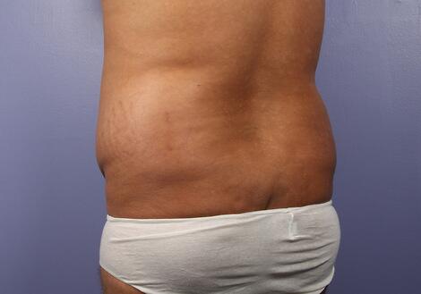 Liposuction Before & After Image