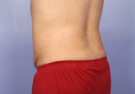 Liposuction Before & After Image