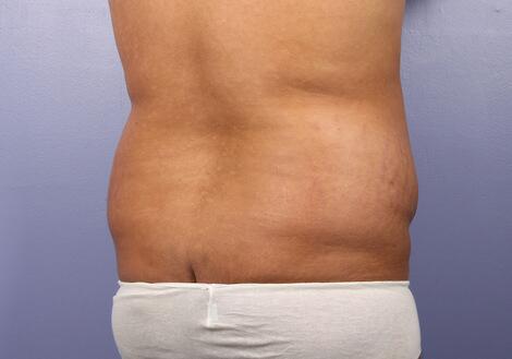 Liposuction Before & After Image