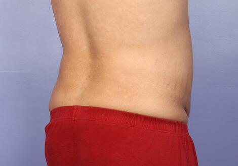 Liposuction Before & After Image