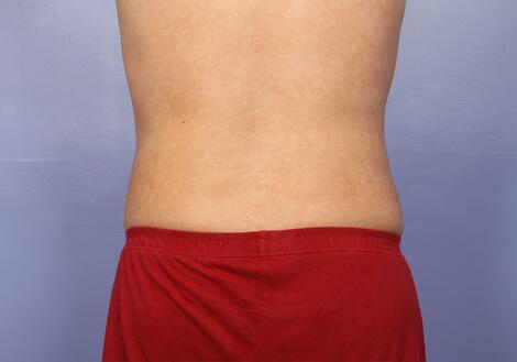 Liposuction Before & After Image