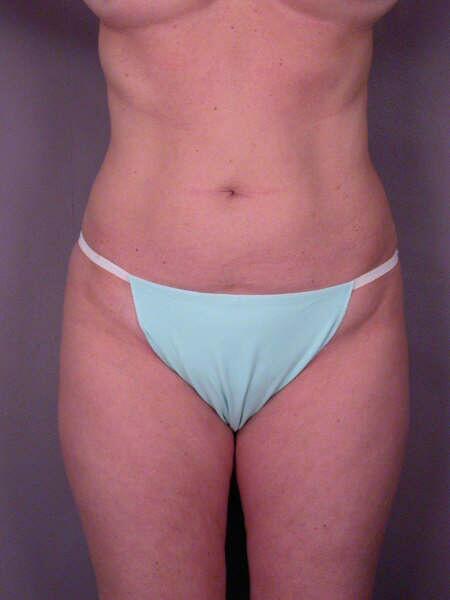 Liposuction Before & After Image