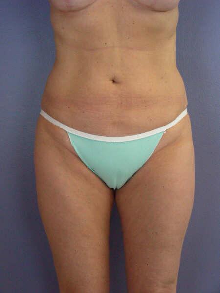 Liposuction Before & After Image