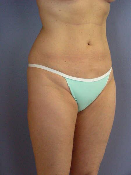 Liposuction Before & After Image