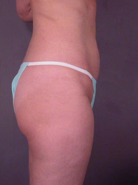 Liposuction Before & After Image