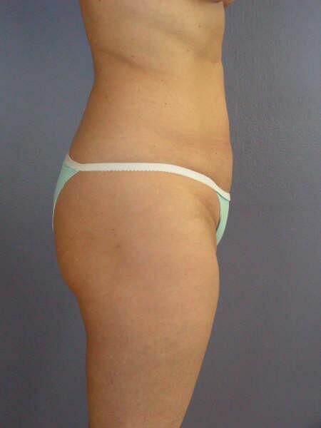 Liposuction Before & After Image