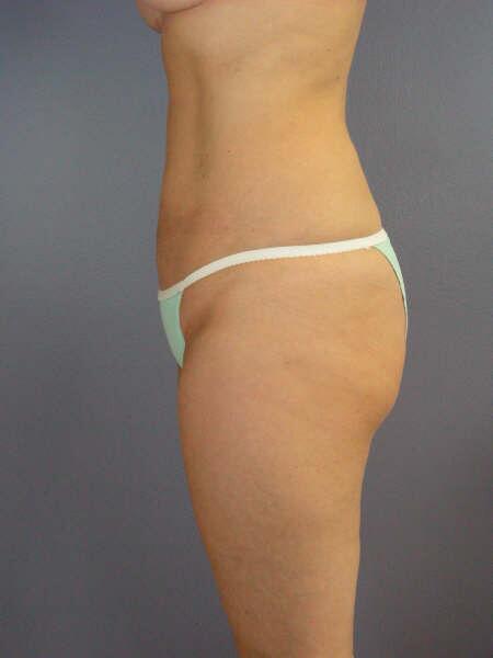 Liposuction Before & After Image