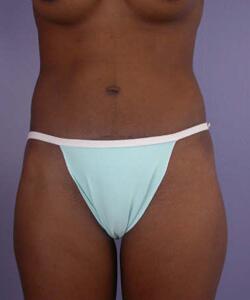 Liposuction Before & After Image