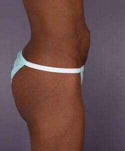 Liposuction Before & After Image