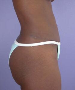 Liposuction Before & After Image