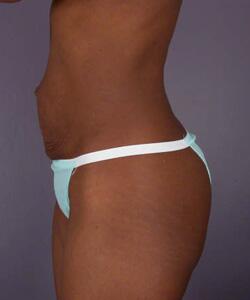 Liposuction Before & After Image