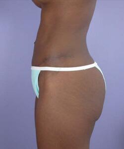 Liposuction Before & After Image