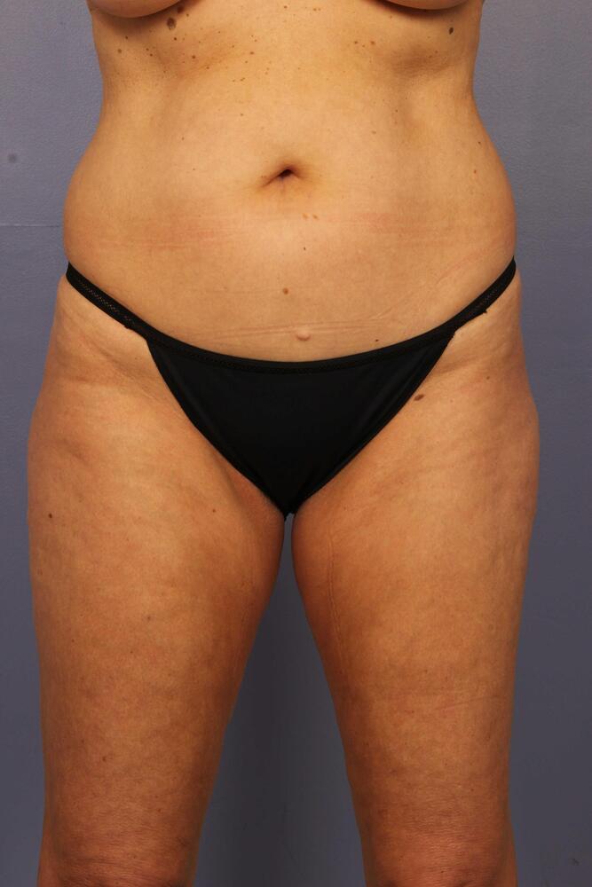 Liposuction Before & After Image