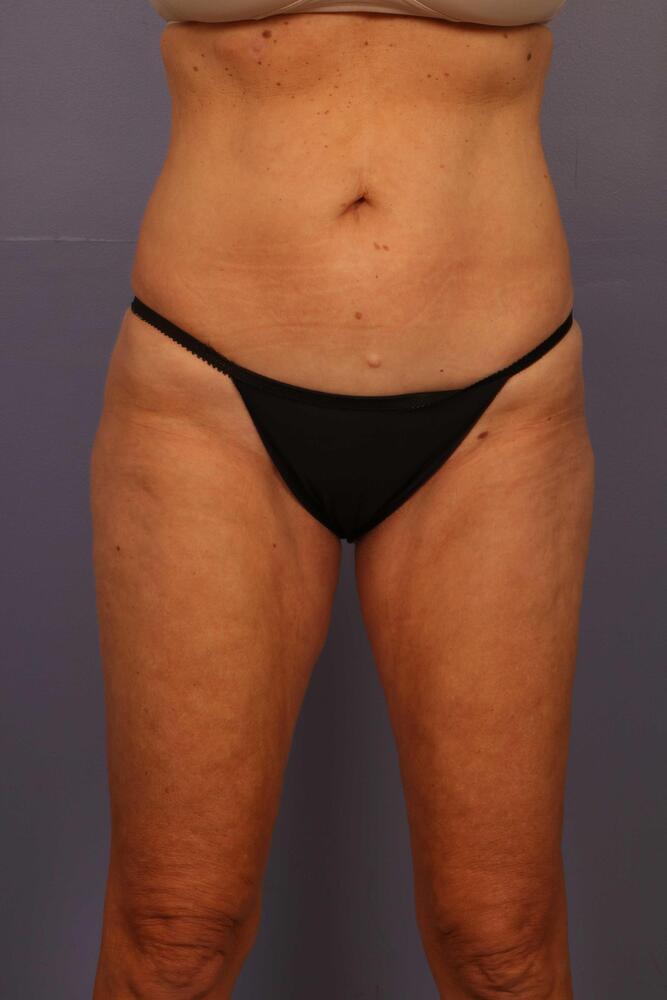 Liposuction Before & After Image