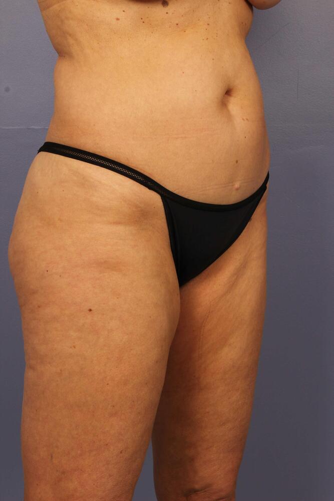 Liposuction Before & After Image