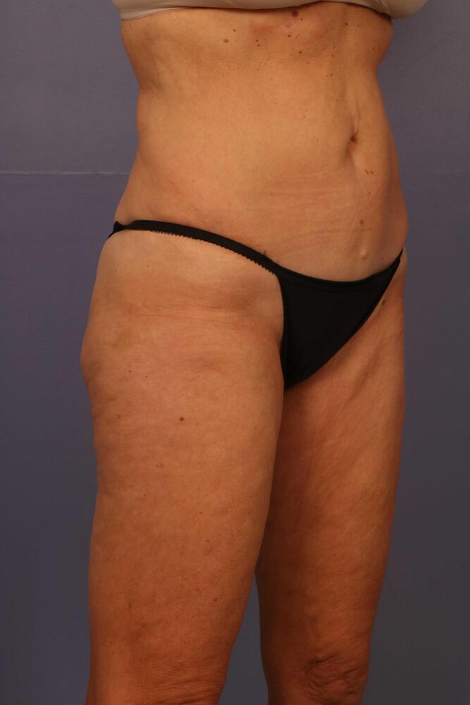 Liposuction Before & After Image