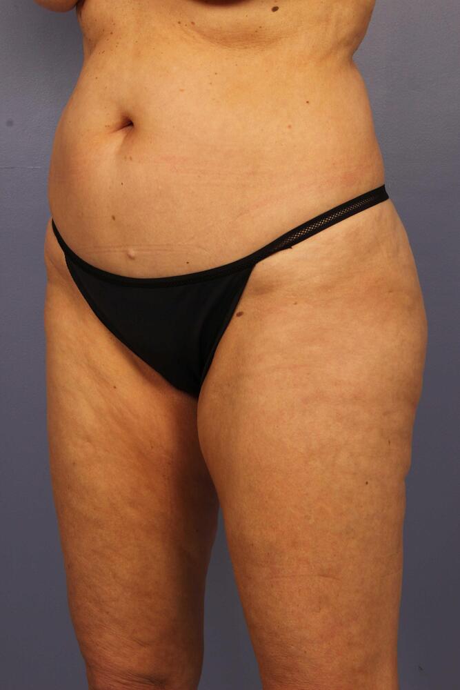 Liposuction Before & After Image