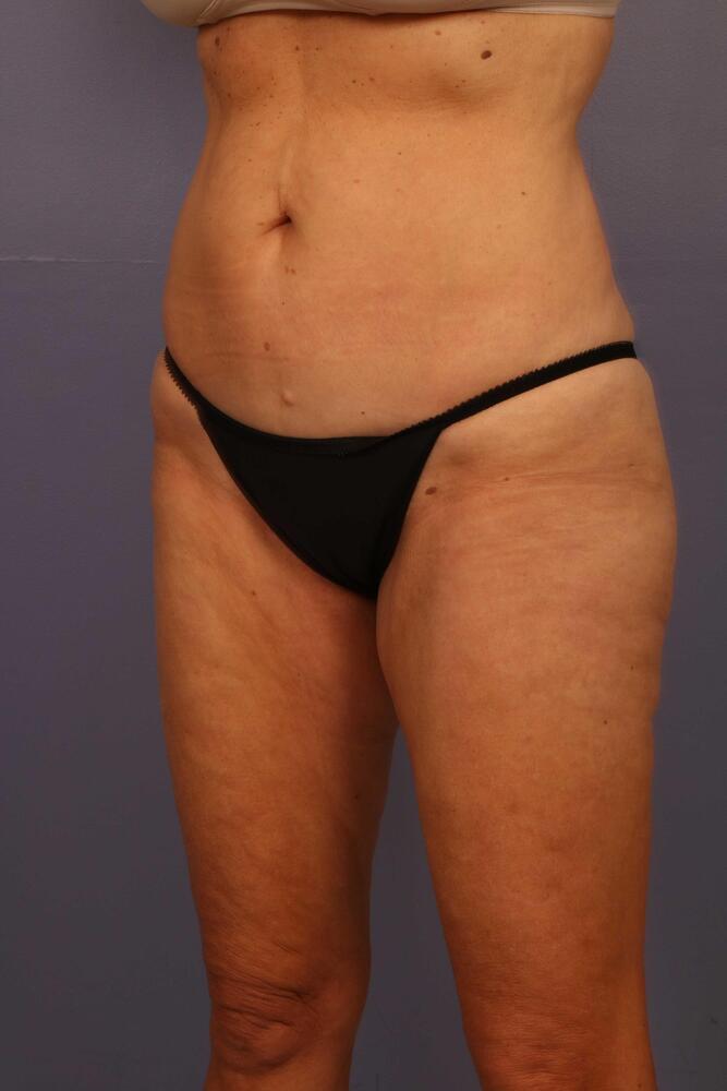 Liposuction Before & After Image