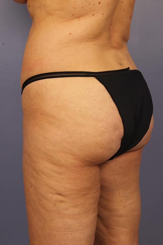 Liposuction Before & After Image