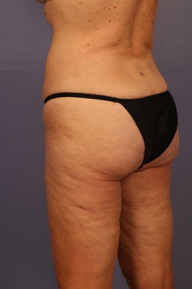 Liposuction Before & After Image