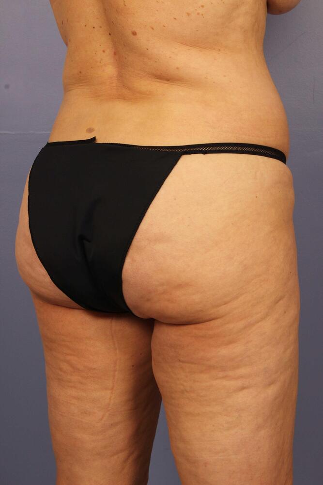 Liposuction Before & After Image