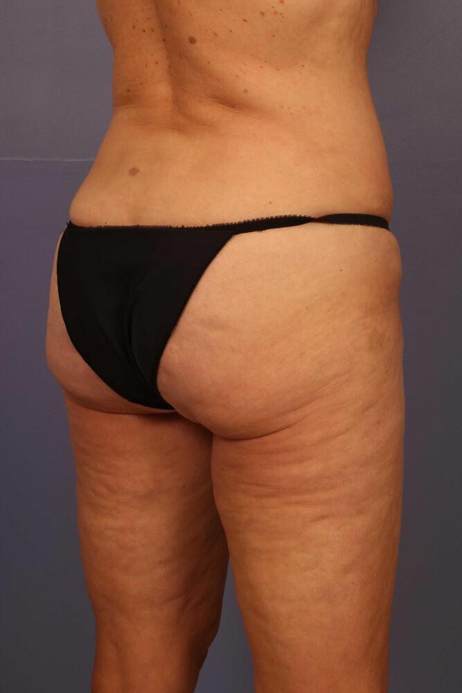 Liposuction Before & After Image