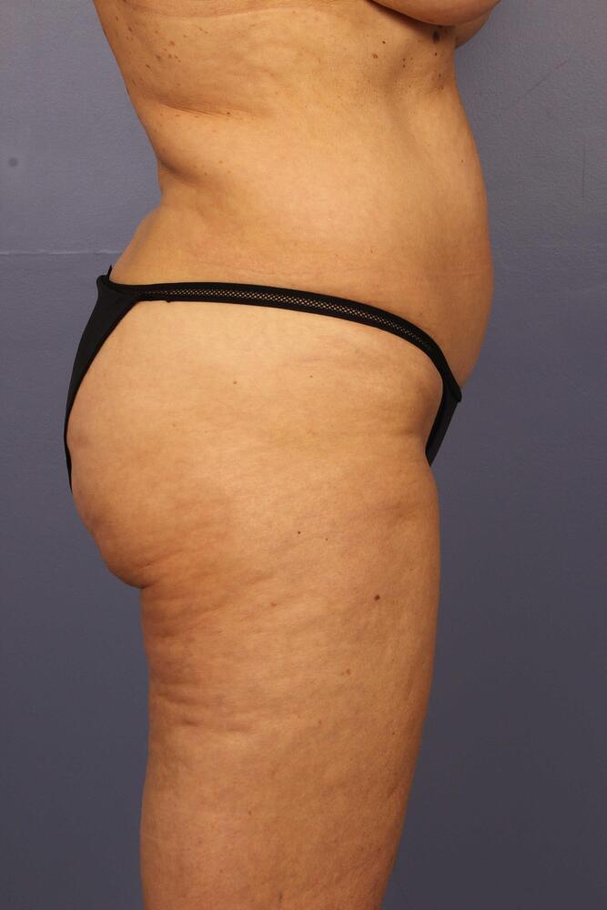 Liposuction Before & After Image