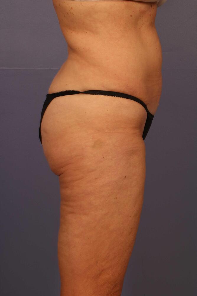 Liposuction Before & After Image