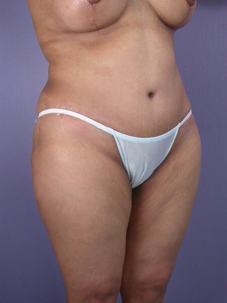 Liposuction Before & After Image