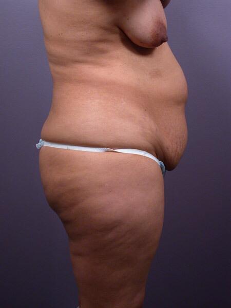 Liposuction Before & After Image