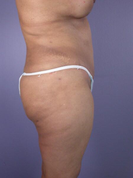 Liposuction Before & After Image