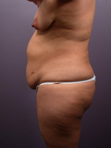 Liposuction Before & After Image