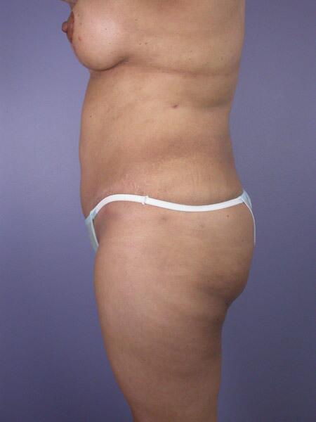 Liposuction Before & After Image