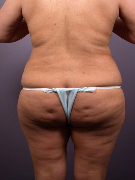 Liposuction Before & After Image